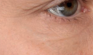 Augenbereich nach der Behandlung mit dem Microneedling Serum von Utsukusy