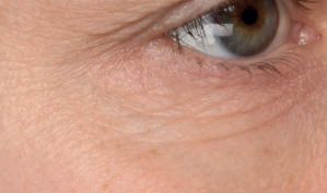 Augenbereich vor der Behandlung mit dem Microneedling Serum Intense Flash von Utsukusy