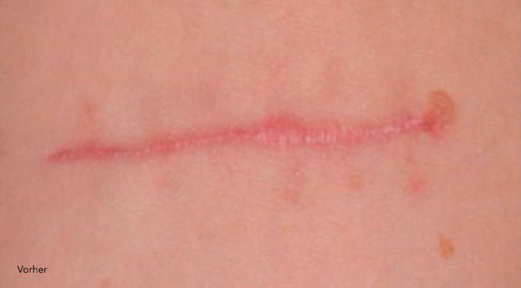 Narbenbild vor der Behandlung mit dem Utsukusy Microneedling Narben Serum