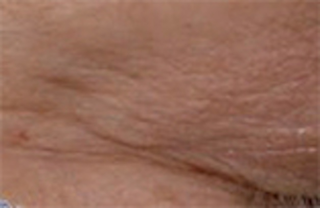 Hautbild nach der Behandlung mit dem Microneedling Eye Lift Cocktail