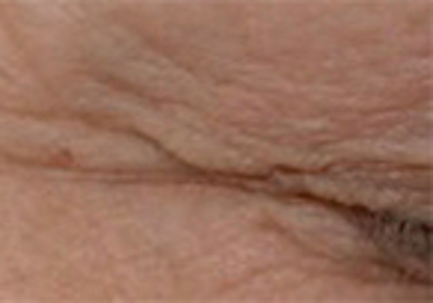 Hautbild vor der Behandlung mit dem Microneedling Eye Lift Cocktail