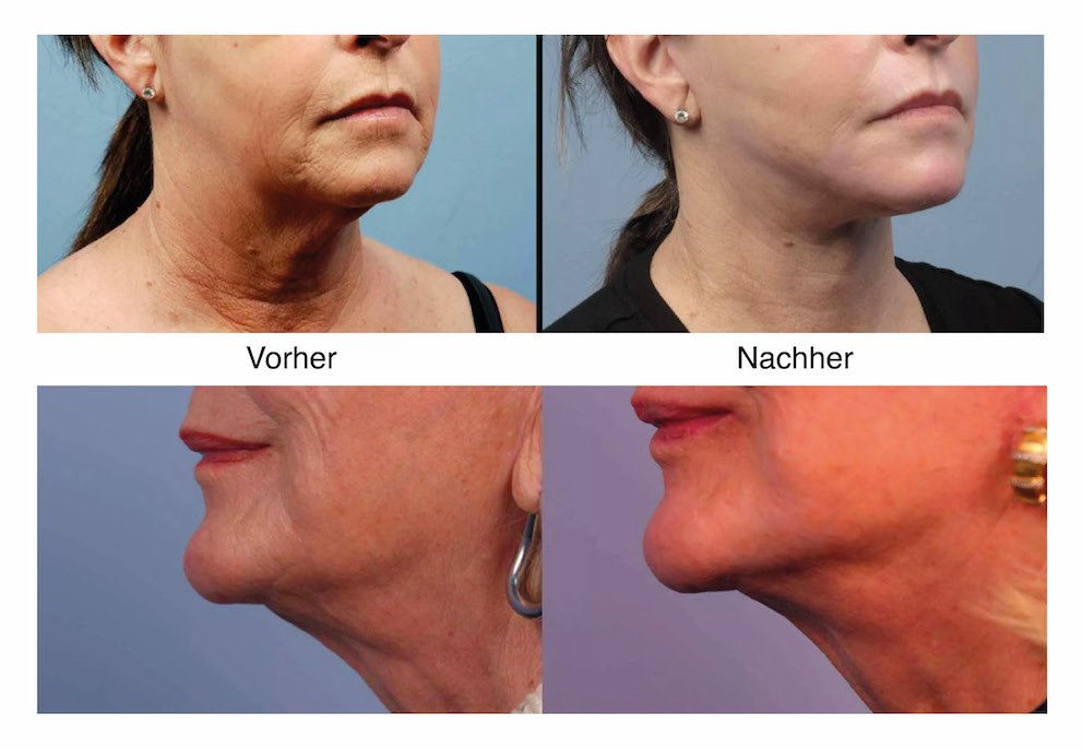 Vorher und nacher Bilder nach Behandlung mit Neck Lift Serum