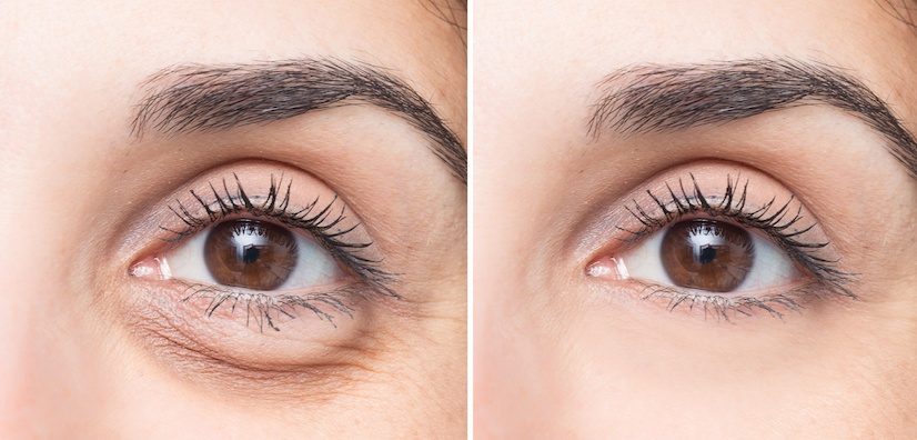 Augenringe mit Microneedling Serum behandeln