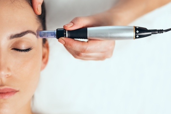 Kosmetische Microneedling Behandlung mit einem Dermapen